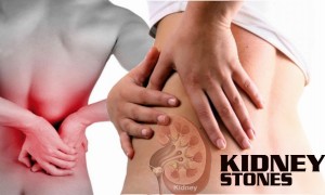 The Worst Pain of Your Life – Kidney Stones Part II