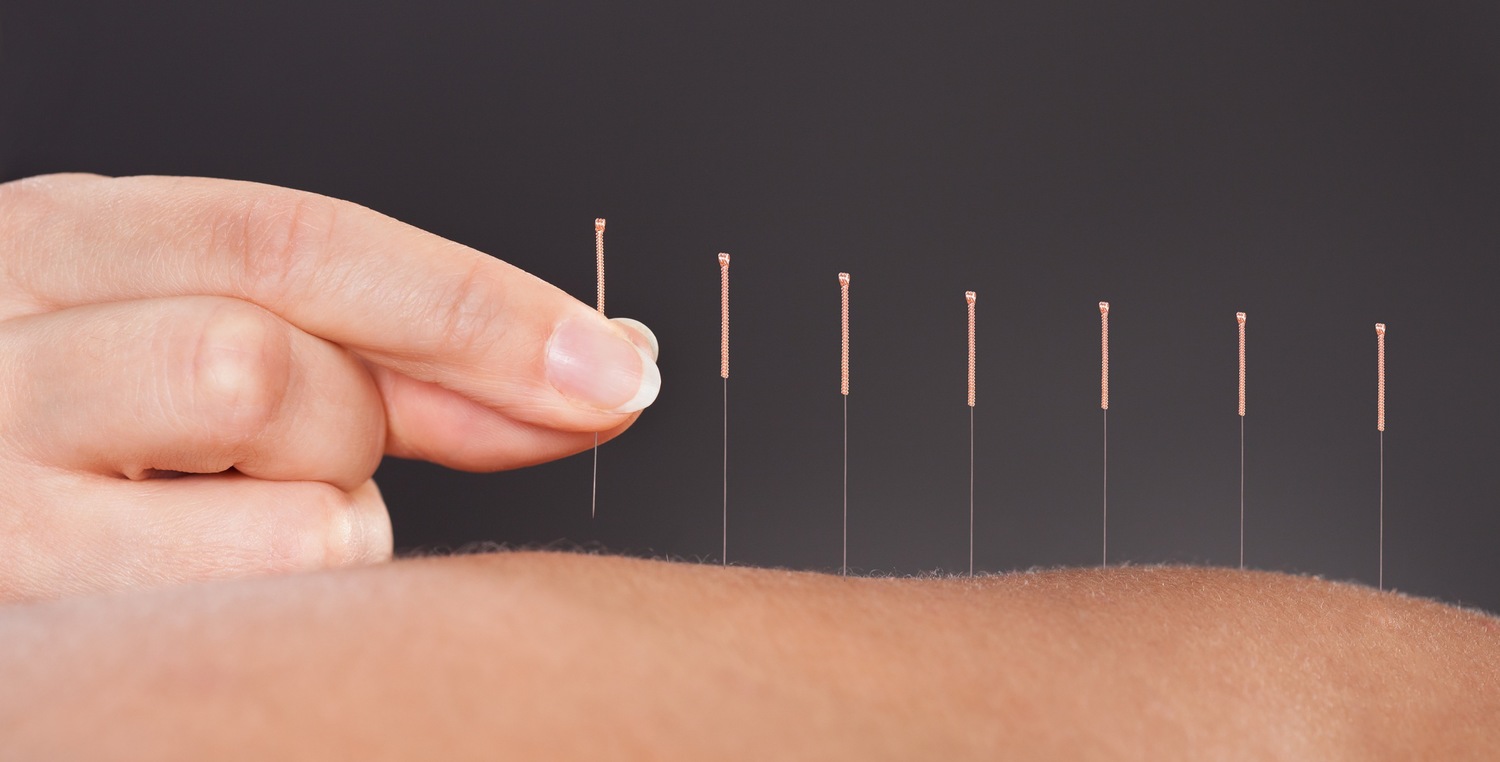 Acupuncture, Part I