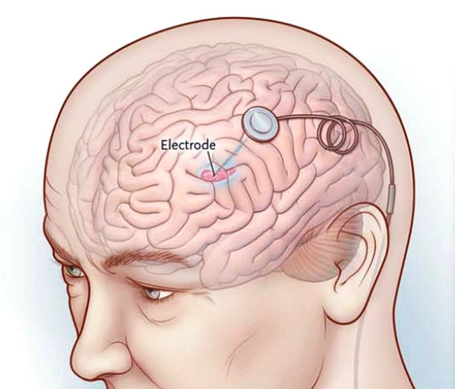 Pain Pacemakers for the Brain: Deep Brain Stimulation