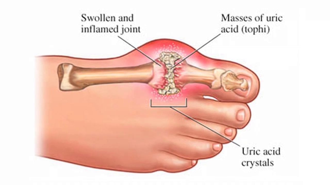 Gout: The King of Pain?