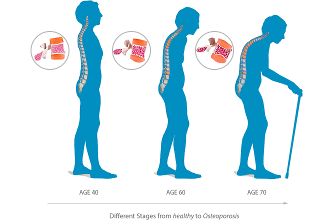 Osteoporosis Silent Searing And Bone Breaking Paul Christo Md