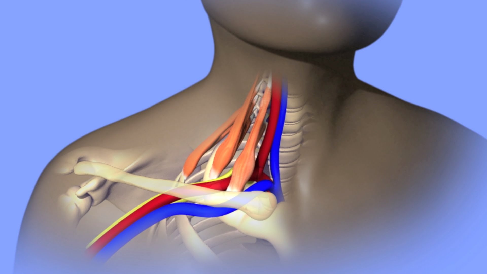 Accidents, Technology, and Thoracic Outlet Syndrome