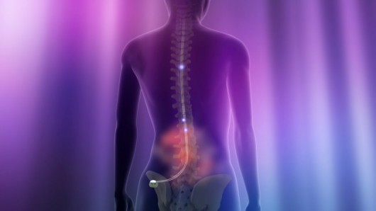 Spinal Cord Stimulation