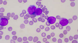 Acute Myeloid Leukemia, Part II